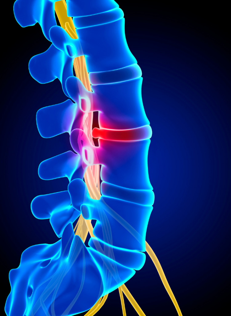 Herniated Disc Lower Back Marietta GA